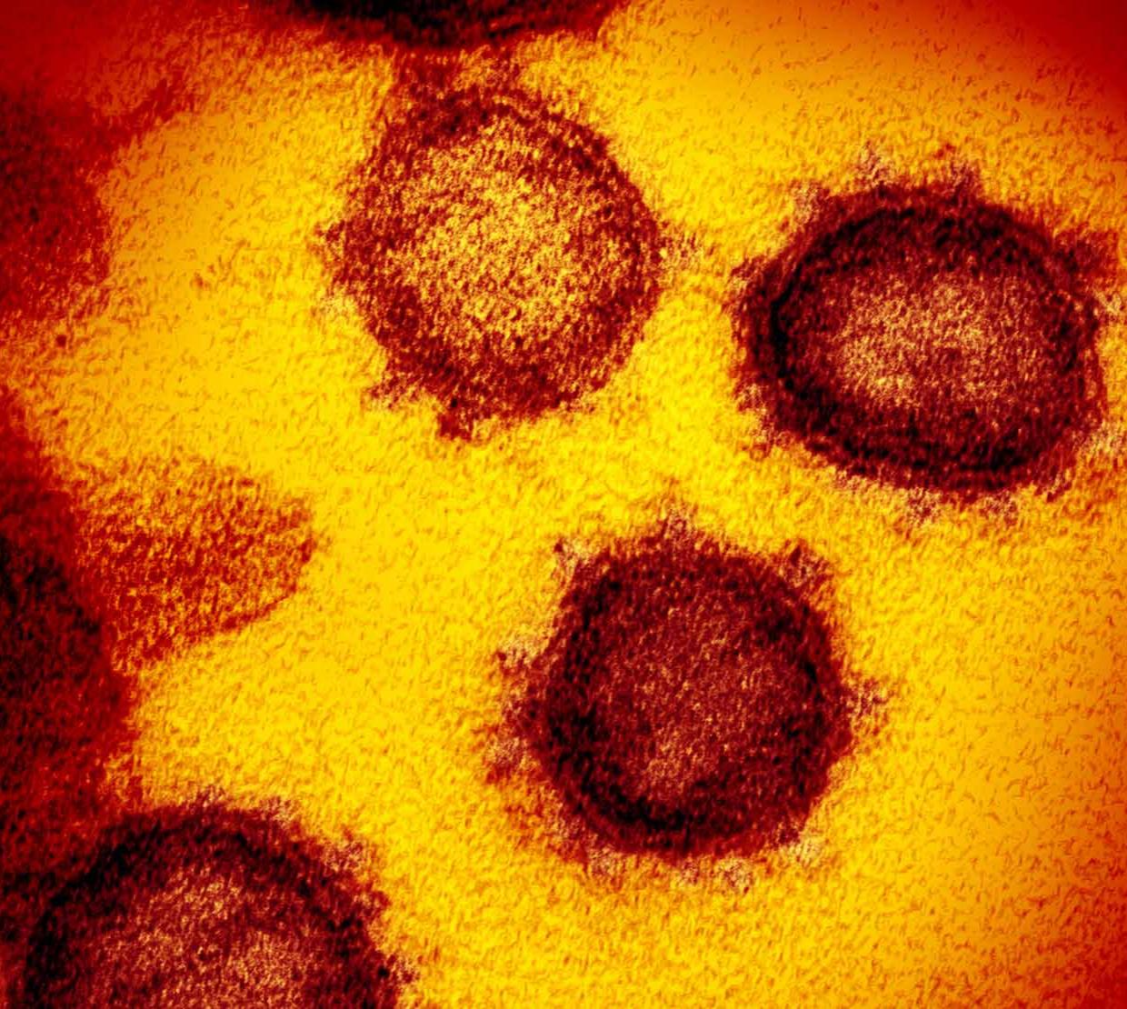 Microscopic image of coronavirus cells